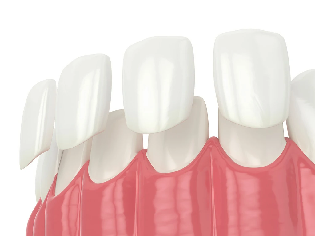 ceramic-dental-crown-for-teeth-whitening
