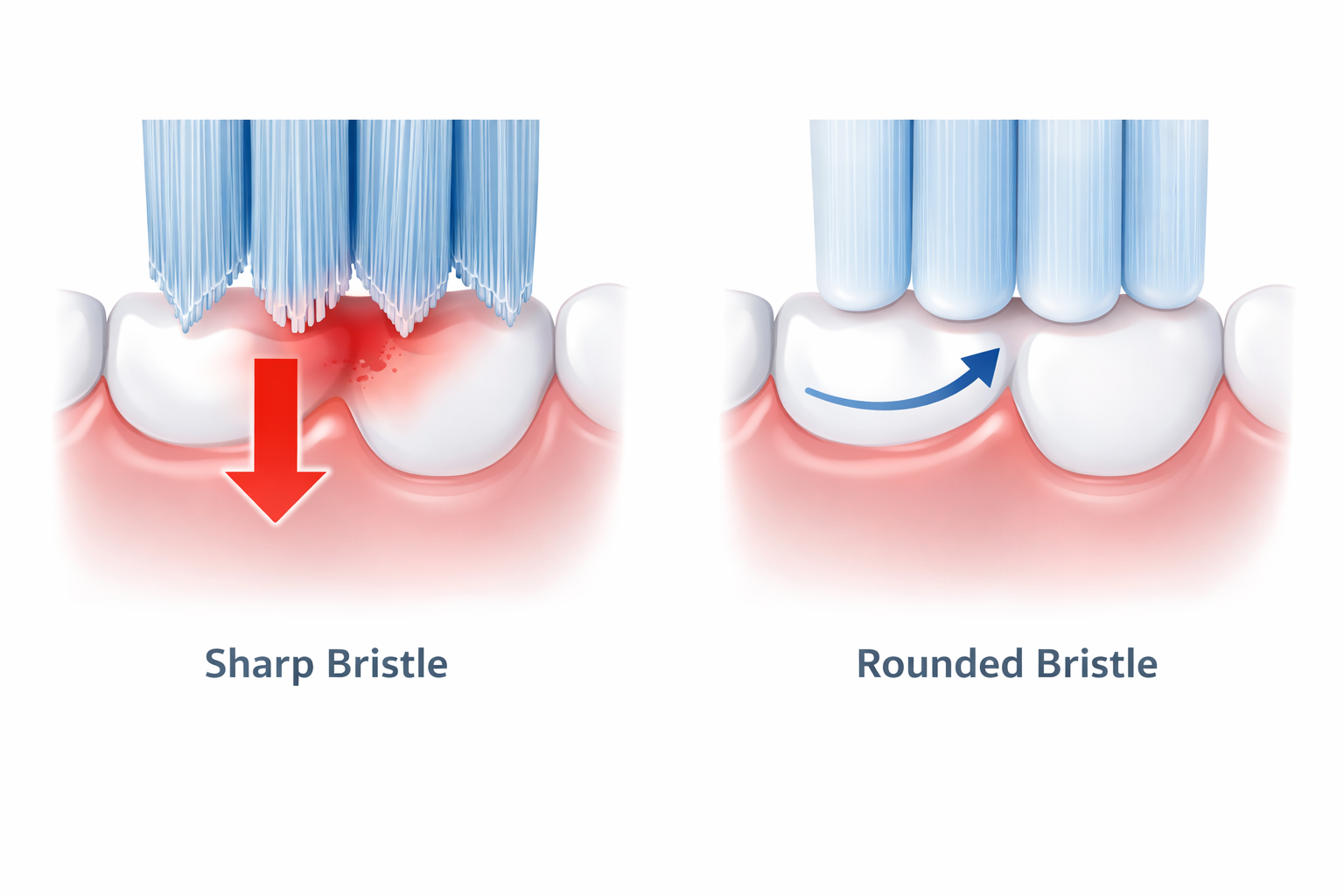 Illustration showing how end-rounded bristles toothbrush reduces gum irritation compared to sharp bristles
