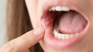 A close-up of a healthy mouth showing a small, white canker sore on the inner cheek.