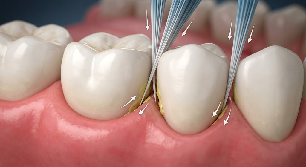 3D illustration of tapered toothbrush bristles penetrating interdental gaps and the gumline
